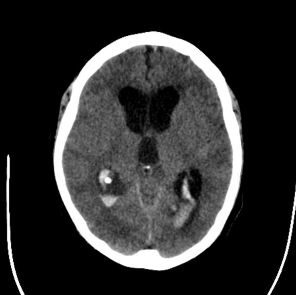 File:Cerebellar hemorrhage causing obstructive hydrocephalus (Radiopaedia 33989-35207 Axial non-contrast 25).jpg