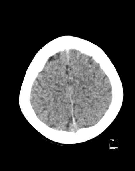 File:Cerebellar stroke (Radiopaedia 32202-33149 Axial non-contrast 25).png