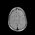 Cerebral abscess post cardiac surgery (Radiopaedia 27244-27420 Axial FLAIR 20).jpg
