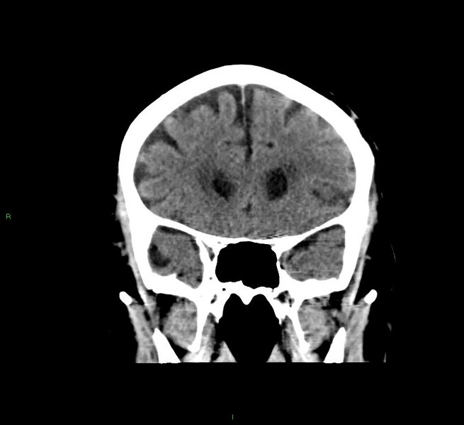 File:Cerebral amyloid angiopathy-associated lobar intracerebral hemorrhage (Radiopaedia 58376-65511 Coronal non-contrast 45).jpg