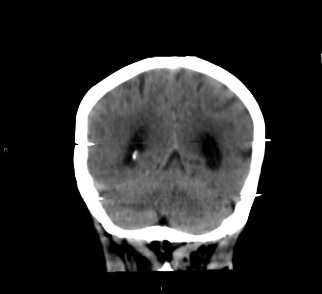 File:Cerebral amyloid angiopathy-associated lobar intracerebral hemorrhage (Radiopaedia 58377-65514 Coronal non-contrast 20).jpg