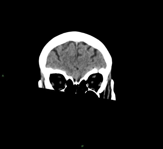 File:Cerebral amyloid angiopathy-associated lobar intracerebral hemorrhage (Radiopaedia 58378-65516 Coronal non-contrast 50).jpg