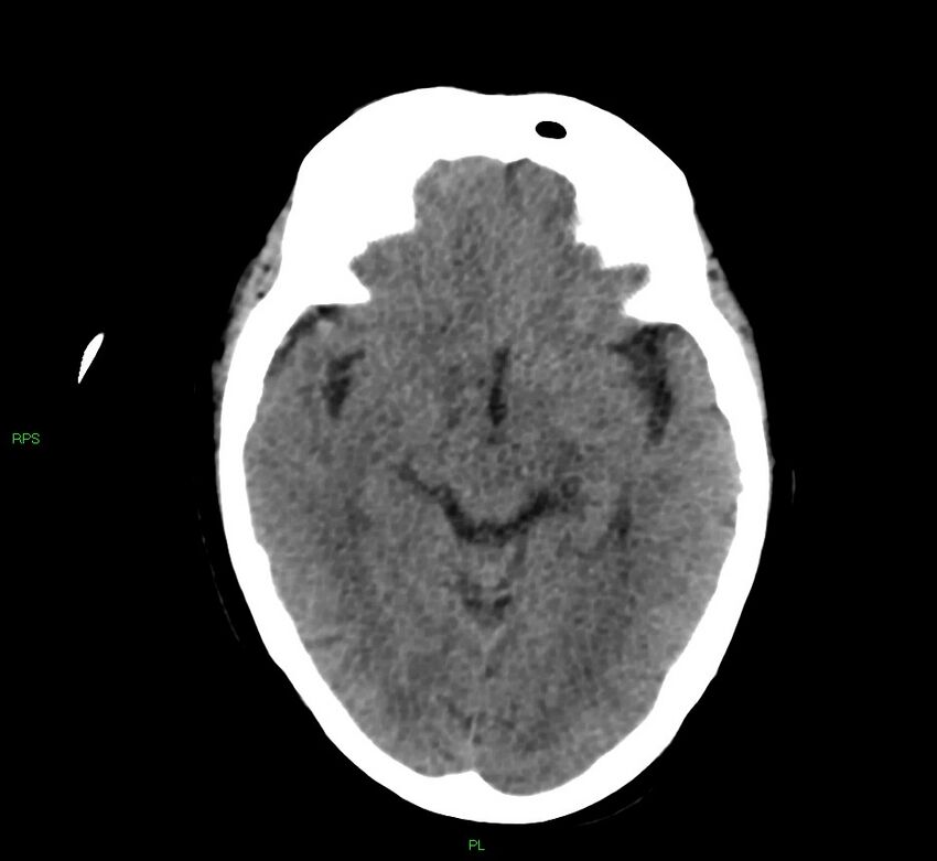 Cerebral amyloid angiopathy-associated lobar intracerebral hemorrhage (Radiopaedia 58569-65734 Axial non-contrast 37).jpg