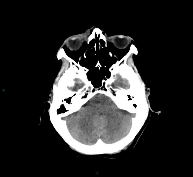 File:Cerebral amyloid angiopathy-associated lobar intracerebral hemorrhage (Radiopaedia 58751-65972 Axial non-contrast 39).jpg