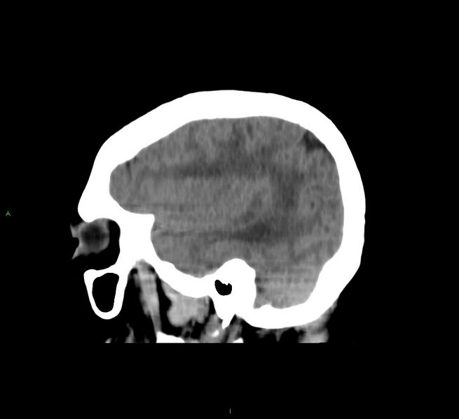 File:Cerebral amyloid angiopathy-associated lobar intracerebral hemorrhage (Radiopaedia 58751-65972 C 41).jpg