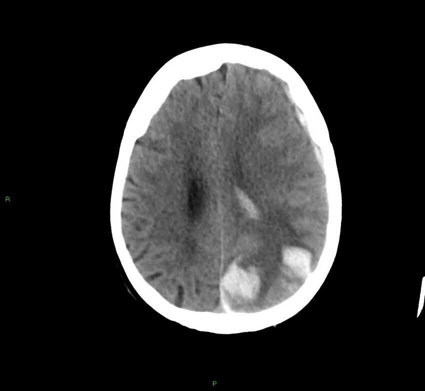 Cerebral amyloid angiopathy-associated lobar intracerebral hemorrhage (Radiopaedia 58754-65975 Axial non-contrast 26).jpg