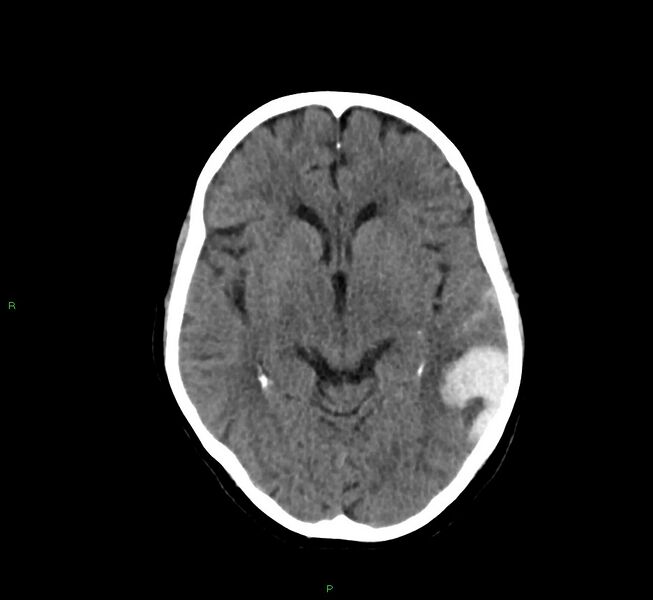 File:Cerebral amyloid angiopathy-associated lobar intracerebral hemorrhage (Radiopaedia 58757-65978 Axial non-contrast 30).jpg