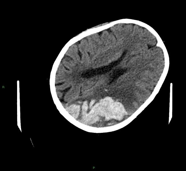 File:Cerebral amyloid angiopathy-associated lobar intracerebral hemorrhage (Radiopaedia 58757-65979 Axial non-contrast 79).jpg