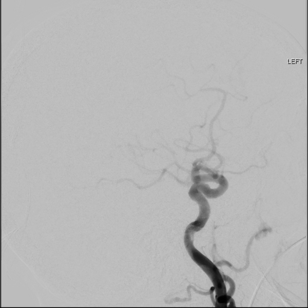 File:Cerebral arteriovenous malformation with lobar hemorrhage (Radiopaedia 44725-48513 LT CCA IC 33).png