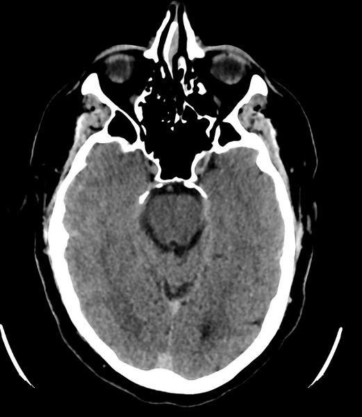 File:Cerebral dural venous sinus thrombosis (Radiopaedia 86514-102575 Axial non-contrast 16).jpg