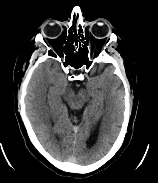 File:Cerebral dural venous sinus thrombosis (Radiopaedia 86514-102575 Axial non-contrast 18).jpg