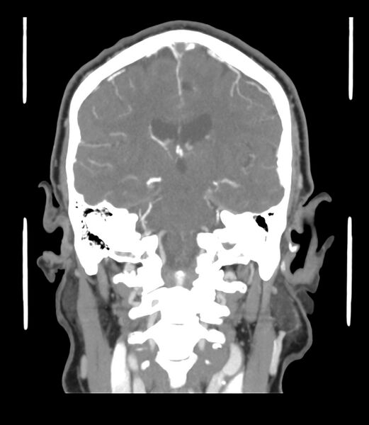 File:Cerebral dural venous sinus thrombosis (Radiopaedia 86514-102576 B 41).jpg