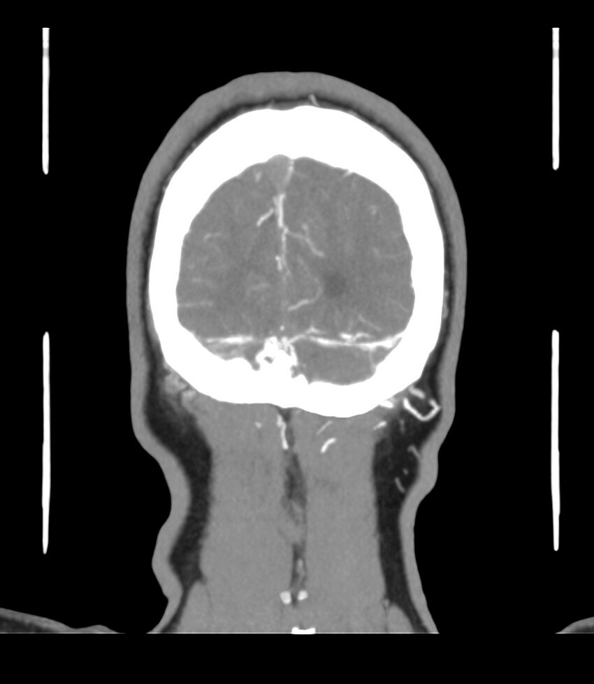 Cerebral dural venous sinus thrombosis (Radiopaedia 86514-102576 B 70).jpg