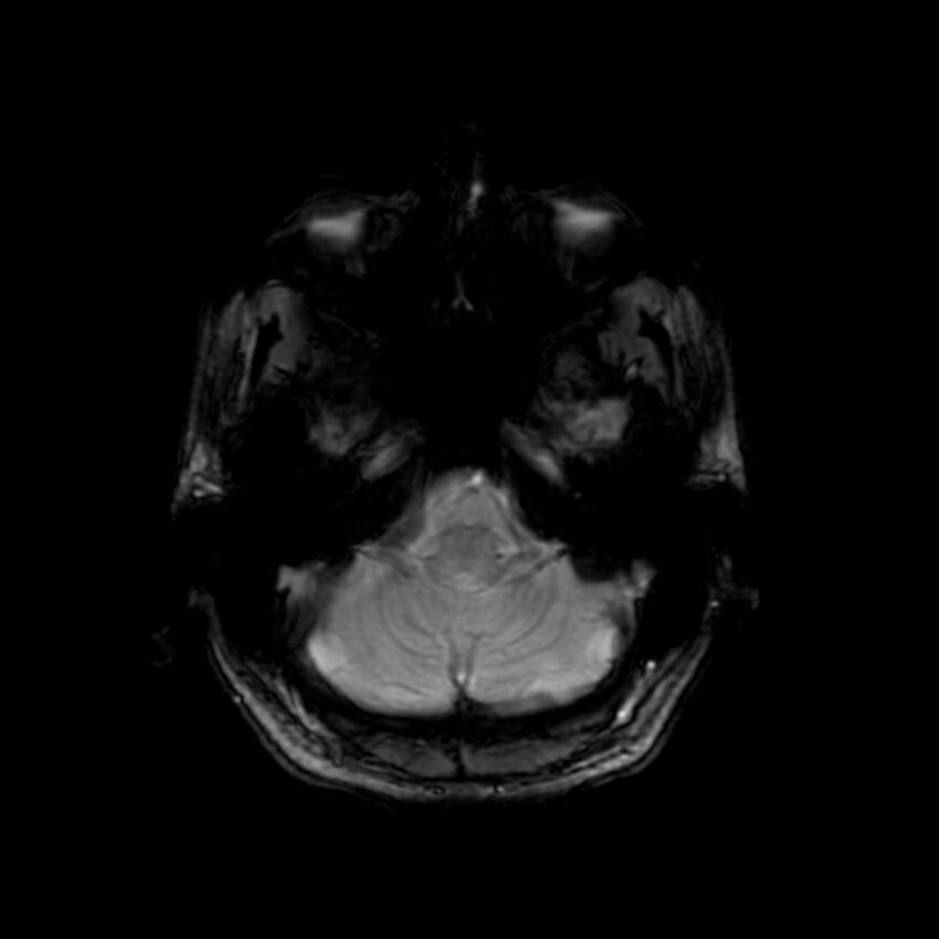 Cerebral paragonimiasis (Radiopaedia 73473-84238 Axial SWI 14).jpg