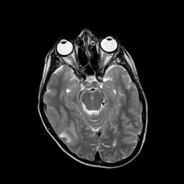 File:Cerebral tuberculoma (Radiopaedia 41152-43932 Axial T2 8).jpg