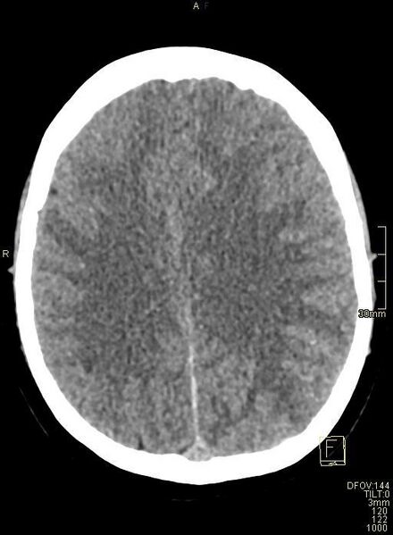 File:Cerebral venous sinus thrombosis (Radiopaedia 91329-108965 Axial non-contrast 34).jpg