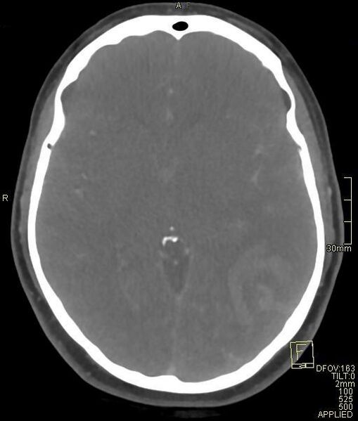 File:Cerebral venous sinus thrombosis (Radiopaedia 91329-108965 Axial venogram 41).jpg
