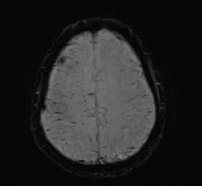 File:Cerebral venous thrombosis (Radiopaedia 71207-81504 Axial SWI 41).jpg