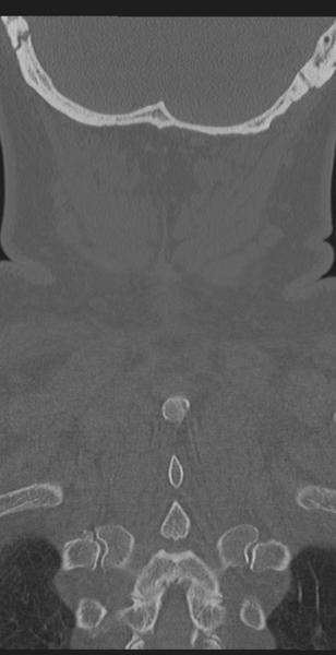 File:Cervical canal stenosis - OPLL and osteophytes (Radiopaedia 47329-51910 Coronal bone window 59).png