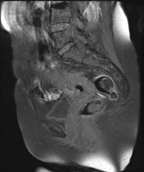 File:Cervical carcinoma (Radiopaedia 88312-104943 Sagittal T1 fat sat 17).jpg