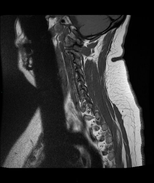 File:Cervical disc prolapse (Radiopaedia 80258-93598 Sagittal T1 13).jpg