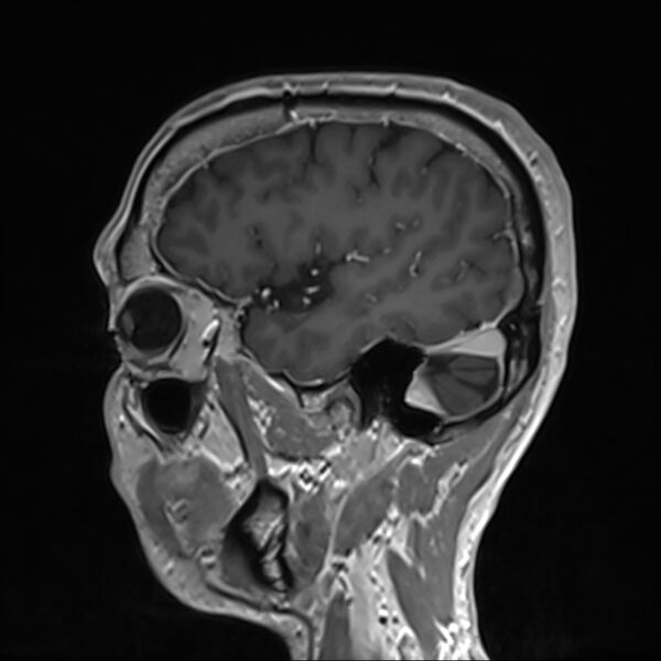 File:Cervical dural CSF leak on MRI and CT treated by blood patch (Radiopaedia 49748-54995 G 15).jpg