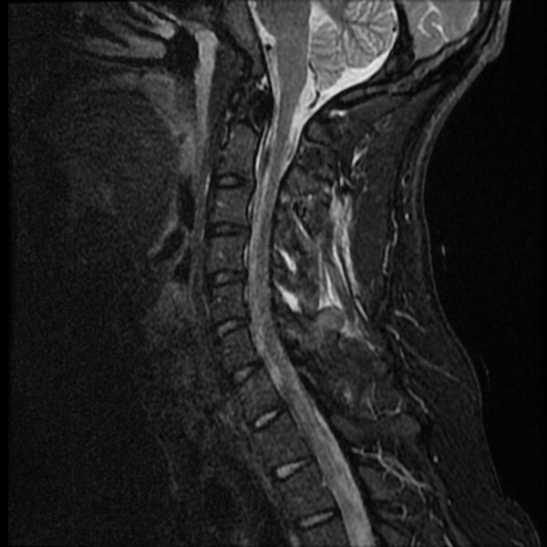 File:Cervical facet fracture and anterior discoligamentous injury (Radiopaedia 32139-33084 Sagittal STIR 10).jpg