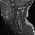 Cervical flexion teardrop fracture with cord hemorrhage (Radiopaedia 32497-33455 Sagittal T1 12).jpg