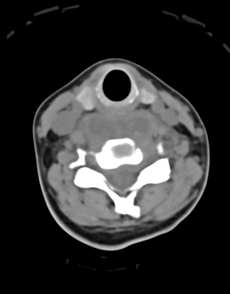 File:Cervical tuberculous spondylitis (Radiopaedia 39149-41365 Axial non-contrast 32).png