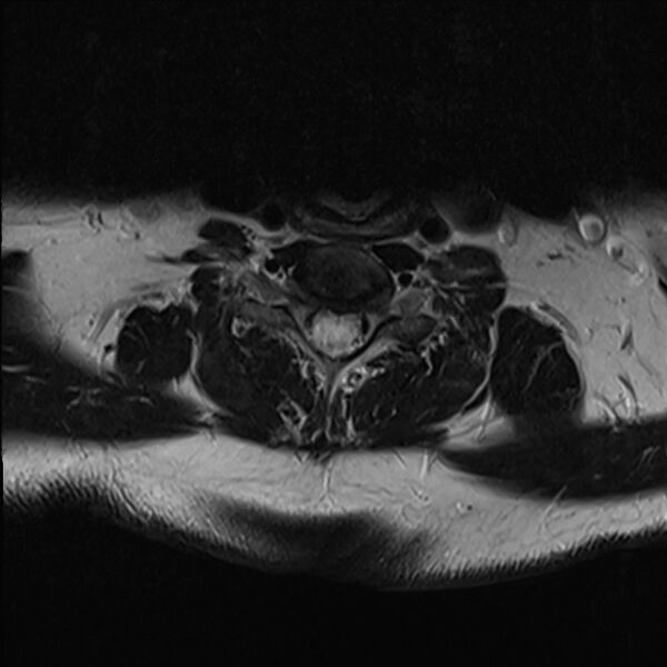 File:Cervical tumor-like myelopathy due to Type V dAVF (Radiopaedia 82461-96604 Axial T2 27).jpg