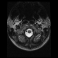 Cervical vertebrae metastasis (Radiopaedia 78814-91667 Axial T2 27).png
