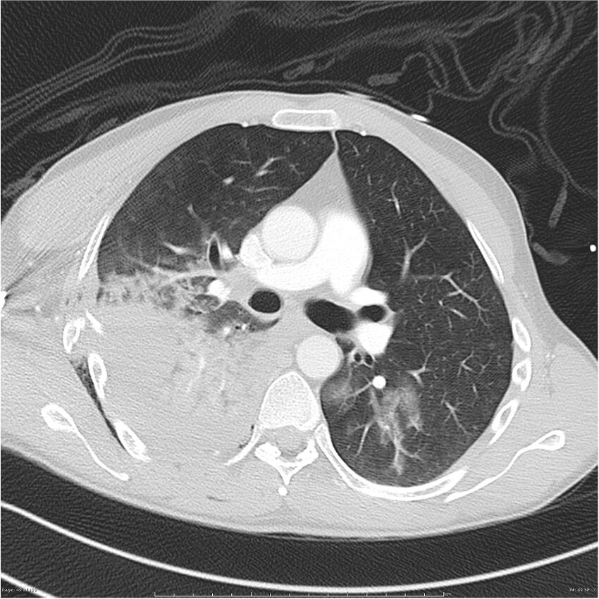 Chest and abdomen multi-trauma (Radiopaedia 26294-26425 lung window 49).jpg