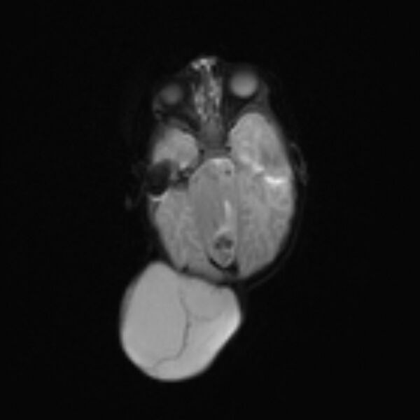 File:Chiari III malformation with occipital encephalocele (Radiopaedia 79446-92559 Axial DWI 11).jpg