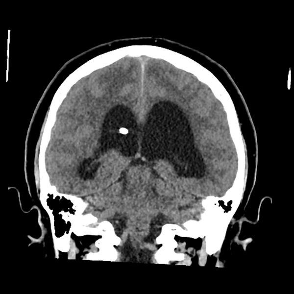 File:Chiasmatic-hypothalamic juvenile pilocytic astrocytoma (Radiopaedia 78533-91237 Coronal non-contrast 44).jpg