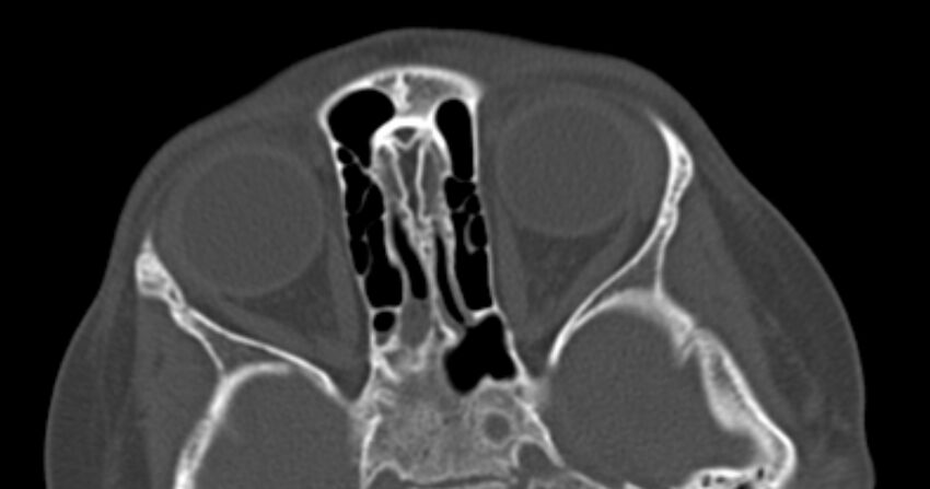 Choanal atresia (Radiopaedia 51295-56972 Axial bone window 47).jpg