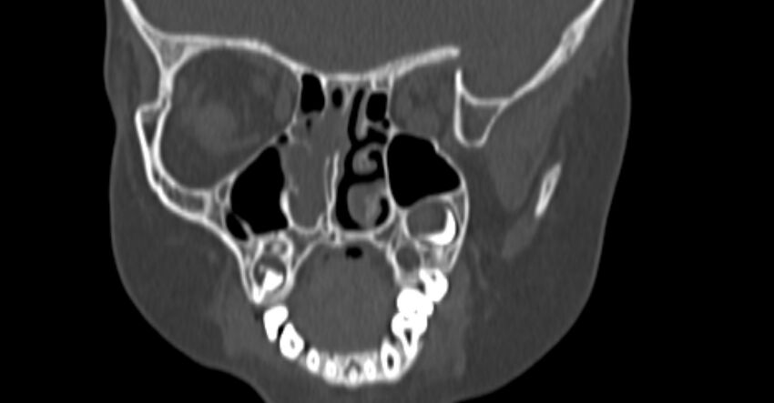 Choanal atresia (Radiopaedia 51295-56972 Coronal bone window 41).jpg