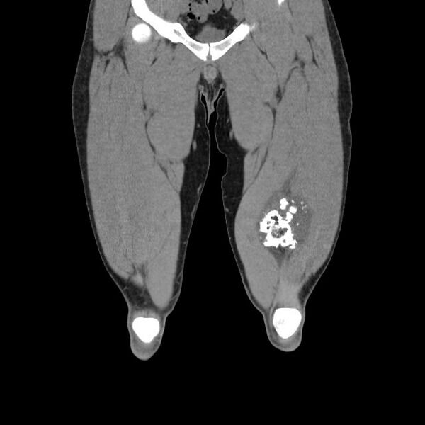 File:Chondrosarcoma arising from exostosis (Radiopaedia 59996-67507 Coronal soft tissue 7).jpg