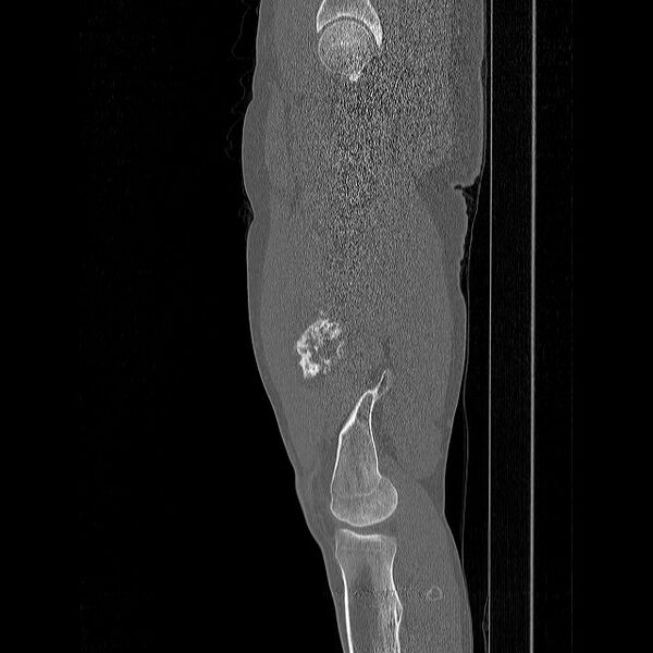 File:Chondrosarcoma arising from exostosis (Radiopaedia 59996-67507 Sagittal bone window 12).jpg