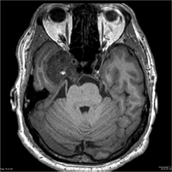 File:Chondrosarcoma of skull base- grade II (Radiopaedia 40948-43654 Axial T1 40).jpg