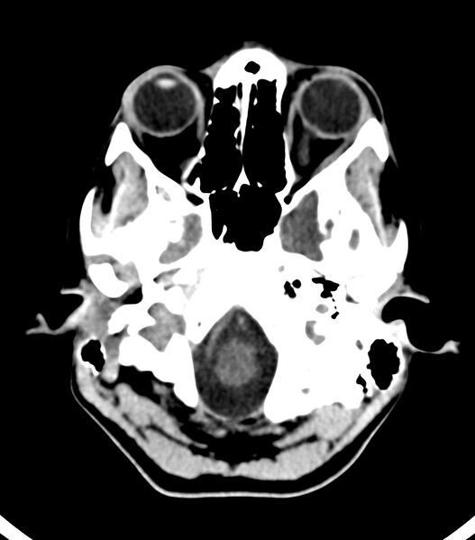 File:Choroid plexus carcinoma (Radiopaedia 91013-108552 Axial non-contrast 11).jpg