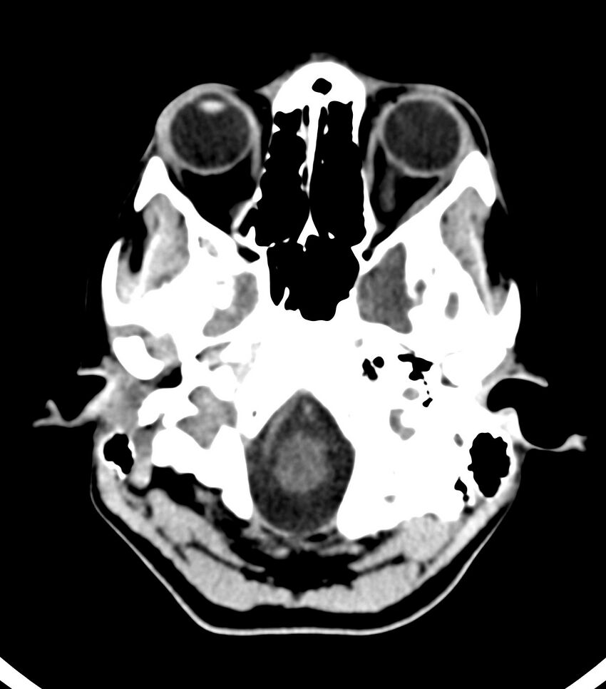Choroid plexus carcinoma (Radiopaedia 91013-108552 Axial non-contrast 11).jpg