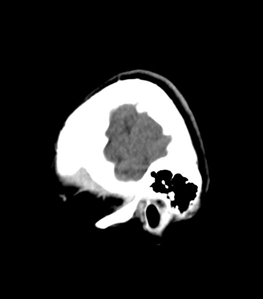 File:Choroid plexus carcinoma (Radiopaedia 91013-108552 B 9).jpg
