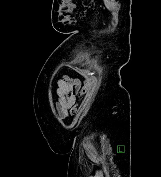 File:Chromophobe renal cell carcinoma (Radiopaedia 84239-99519 G 12).jpg