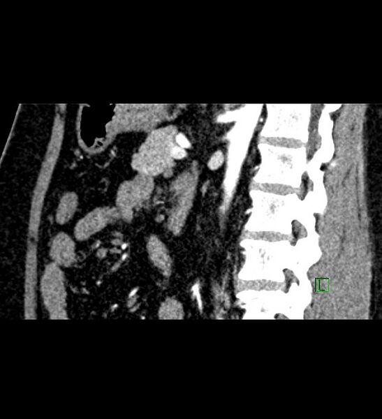 File:Chromophobe renal cell carcinoma (Radiopaedia 84286-99573 F 74).jpg