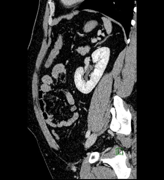 File:Chromophobe renal cell carcinoma (Radiopaedia 84286-99573 I 55).jpg