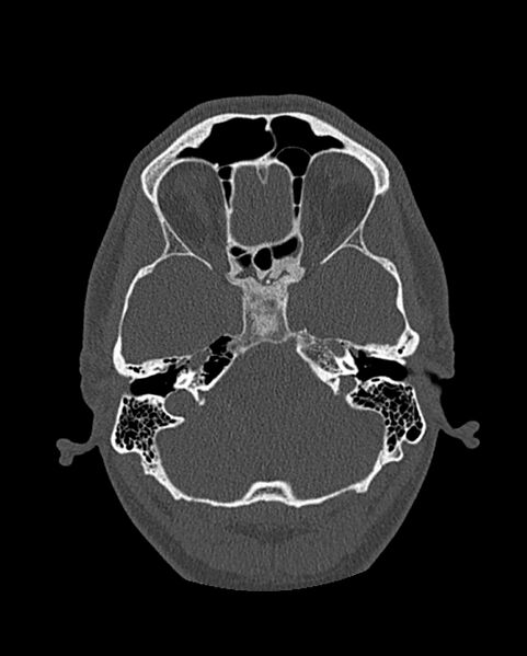File:Chronic maxillary sinusitis caused by a foreign body (Radiopaedia 58521-65676 Axial bone window 238).jpg