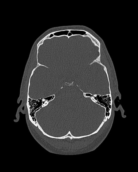 File:Chronic maxillary sinusitis caused by a foreign body (Radiopaedia 58521-65676 Axial bone window 275).jpg