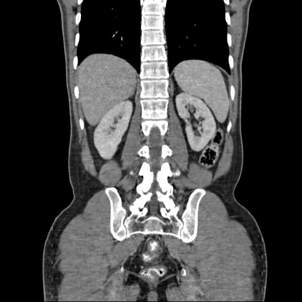 File:Chronic pancreatitis (Radiopaedia 21022-20949 C 15).jpg