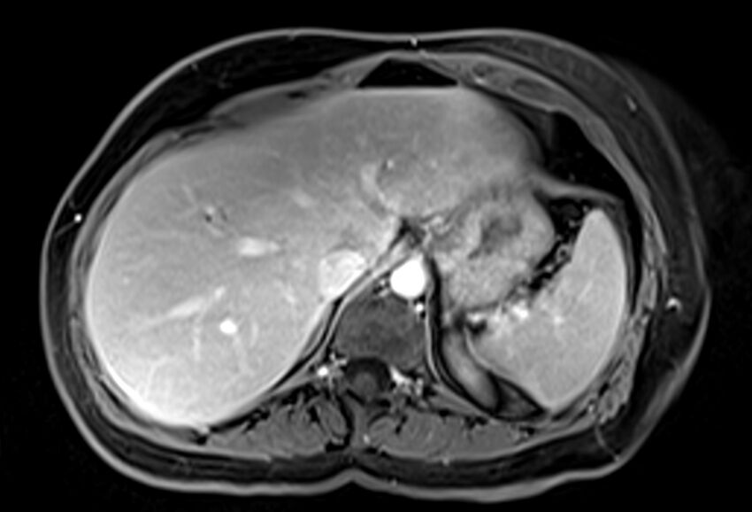 Chronic pancreatitis - pancreatic duct calculi (Radiopaedia 71818-82250 Axial T1 C+ fat sat 13).jpg