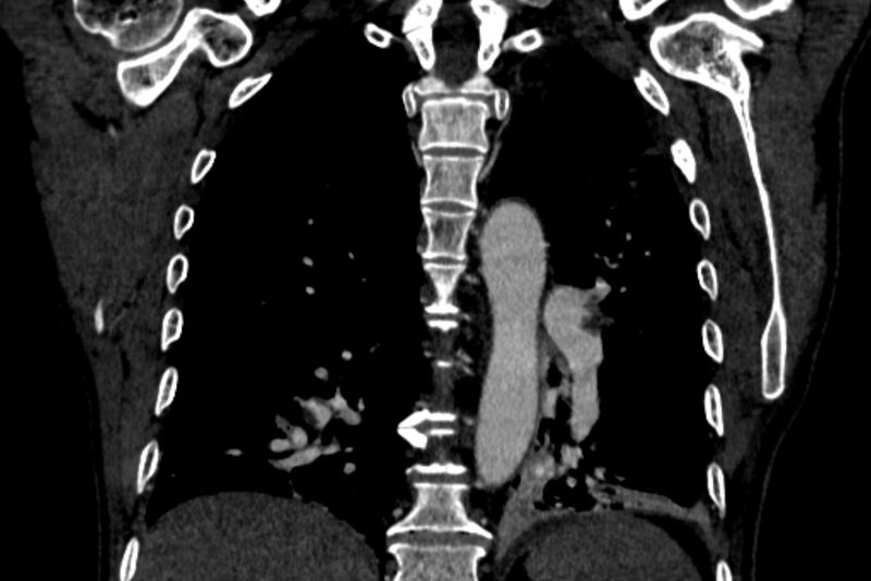 File:Chronic pulmonary embolism with bubbly consolidation (Radiopaedia 91248-108850 B 99).jpg